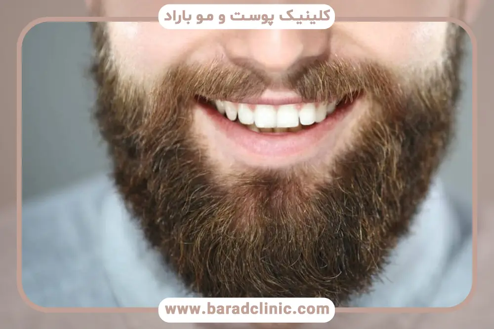 هزینه کاشت کامل سبیل