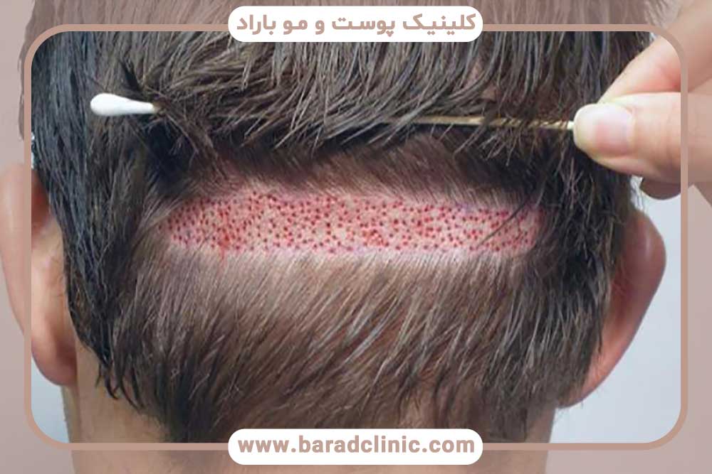 برش سر برای کاشت ابرو