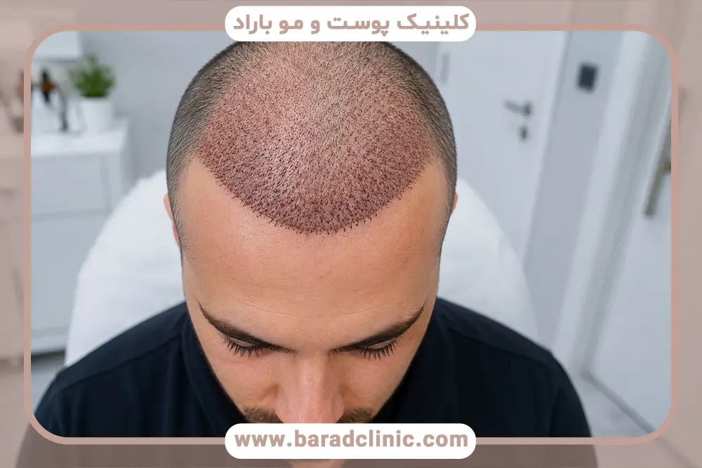 هفته اول بعد از کاشت مو