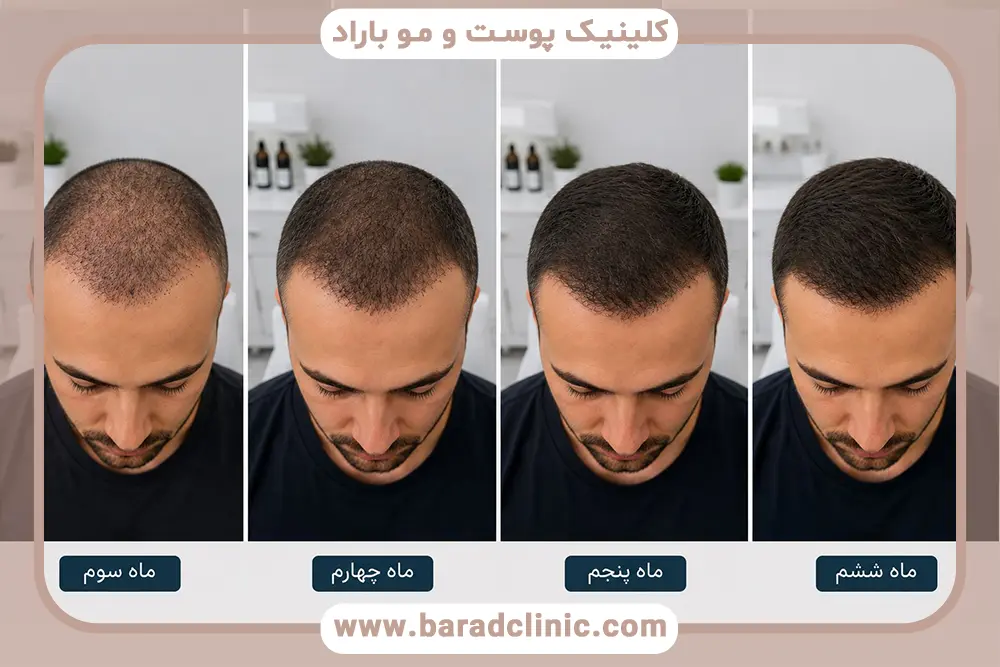 روند رشد مو از ماه چهارم تا ششم بعد از کاشت مو