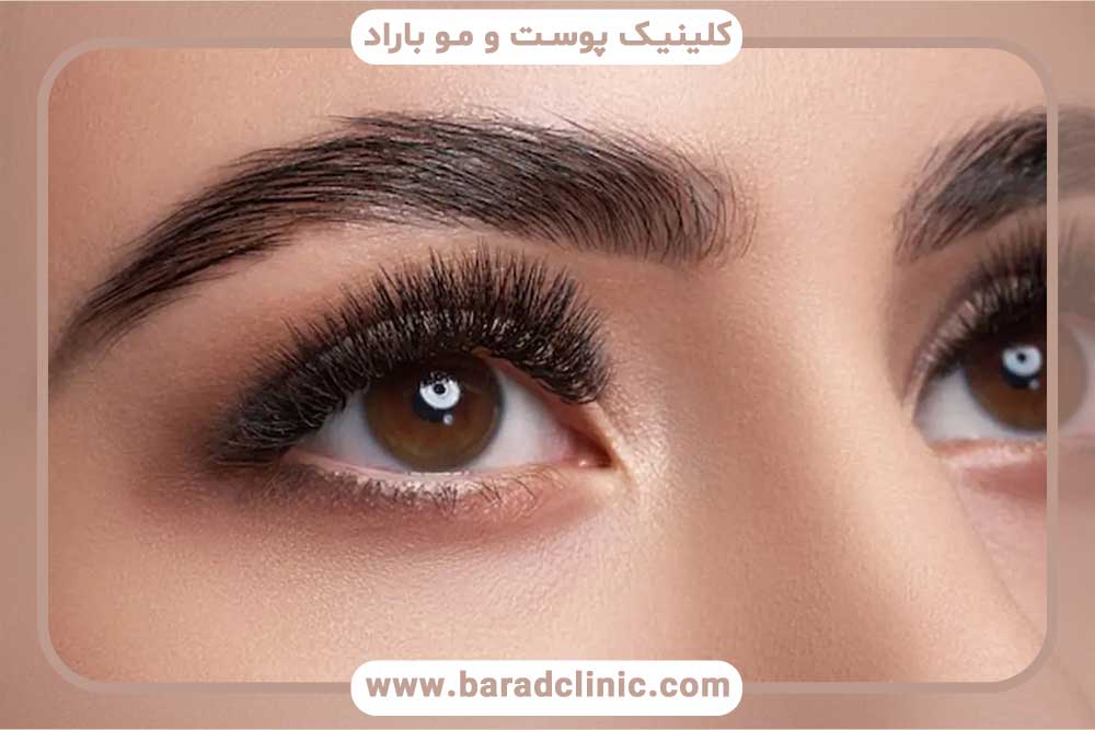کاشت ابرو برای ریزش ابرو