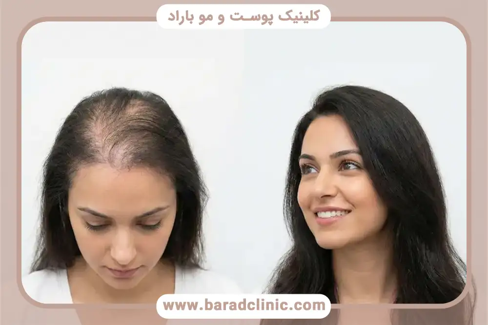 آیا کاشت مو در زنان بدون بانک مو امکان پذیر است؟ 