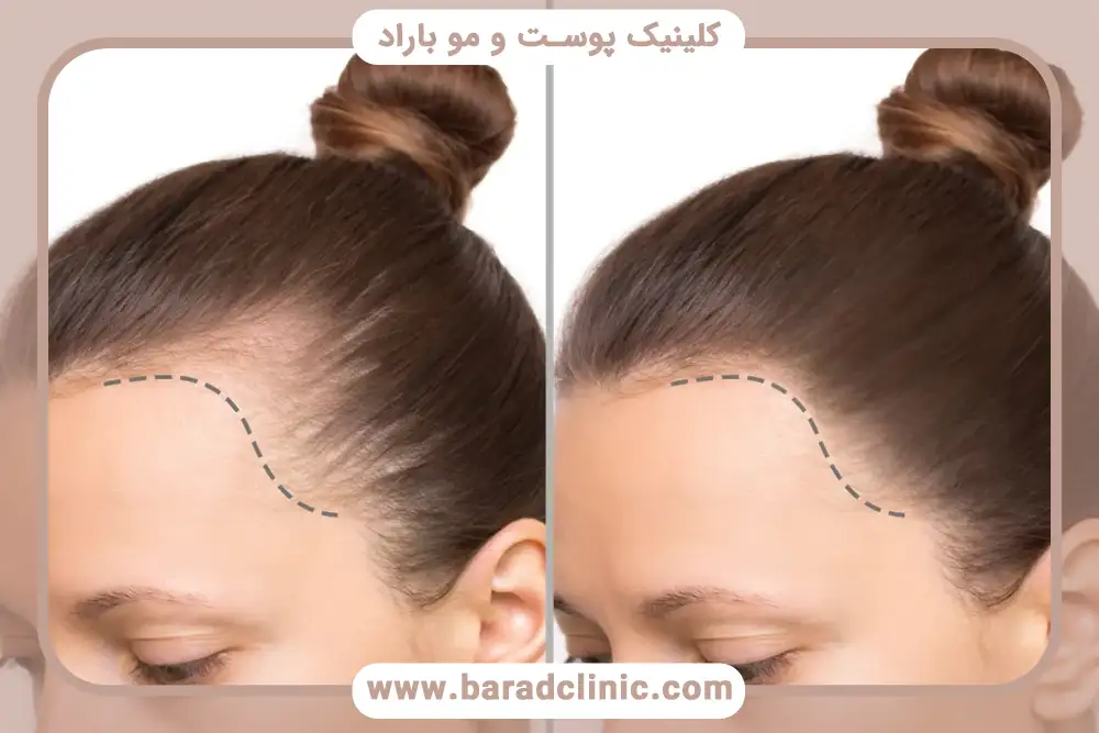 نقش مزوتراپی و PRP در تقویت موهای کم‌پشت