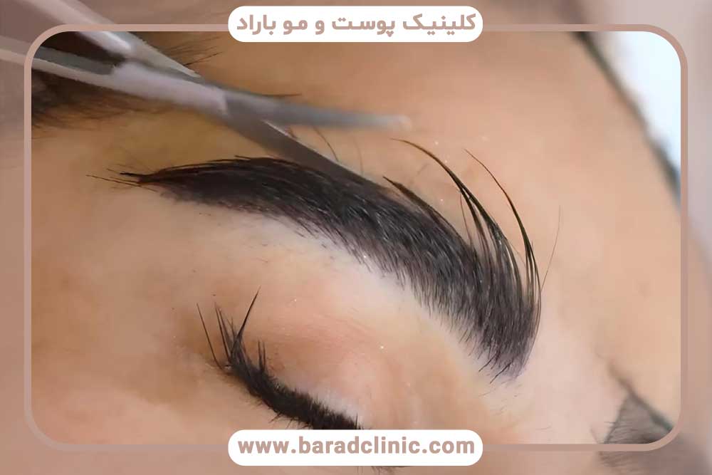 بهترین روش کاشت ابرو