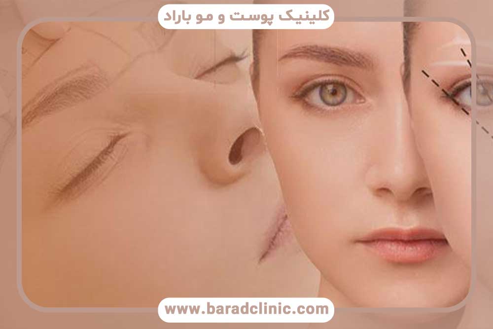 بهترین روش کاشت ابرو