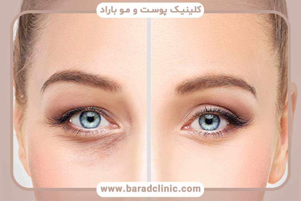 کاشت ابرو کم تراکم