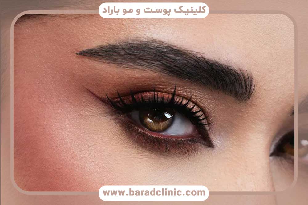 کاشت ابرو پلاس