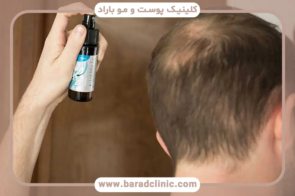 اسپری کاشت موقت مو