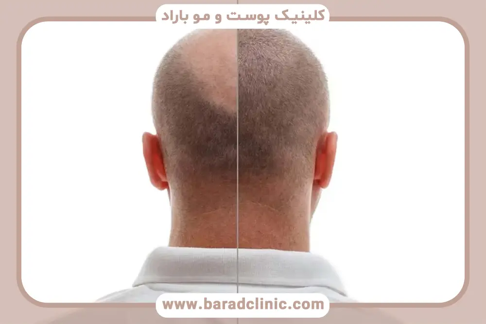 کاشت مو خوبه یا نه