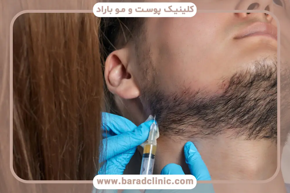 هزینه مزوتراپی ریش و سبیل