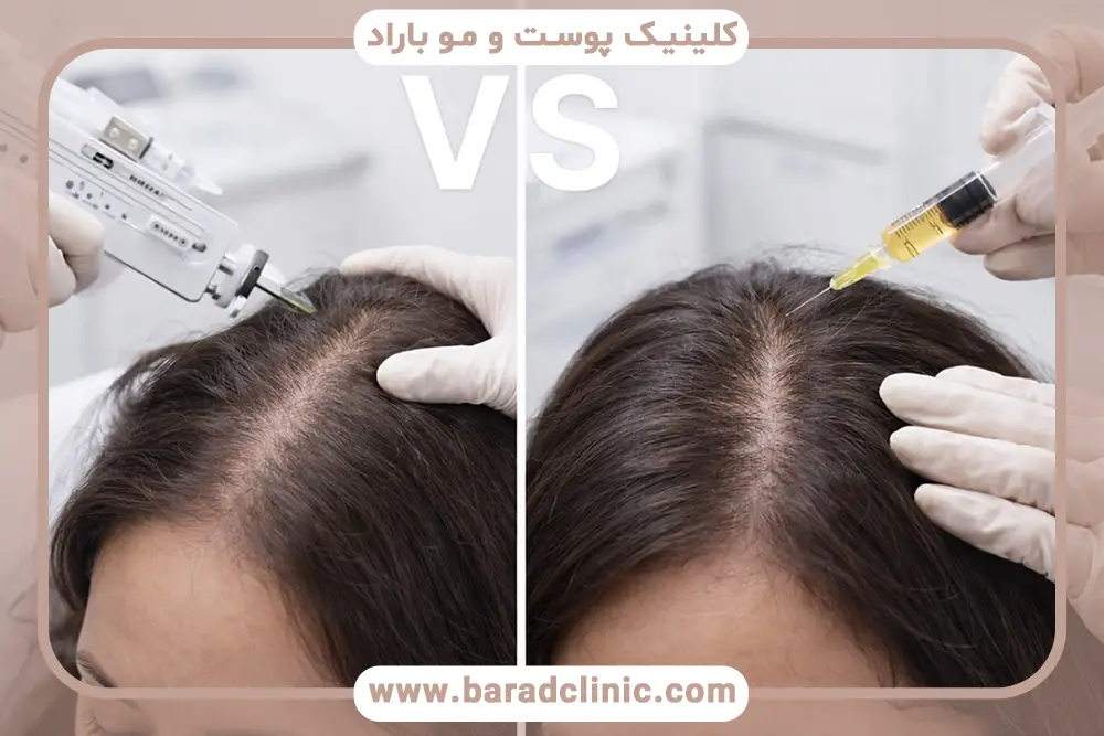 تفاوت مزوتراپی با پی ار پی