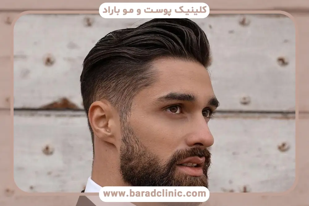 کاشت مو ایده آل
