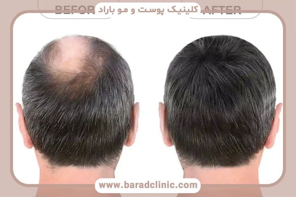 کاشت مو به روش اسکالپ