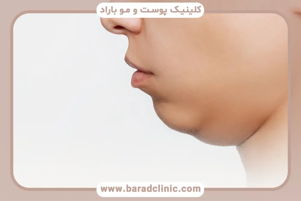prp غبغب چیست؟