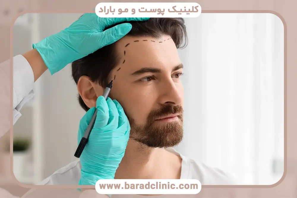 آشنایی با کاشت مو