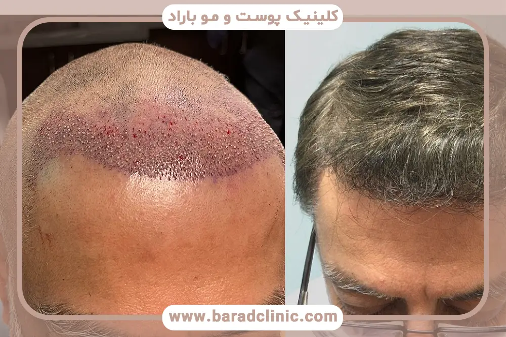 بهترین مکان برای کاشت مو از بین ایران و ترکیه