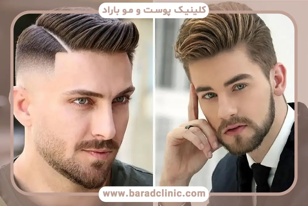 کاشت مو ایده آل چیست؟