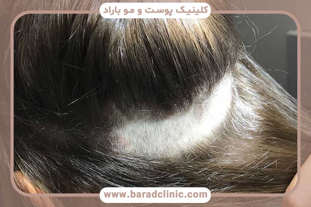 عکس برش سر برای کاشت ابرو