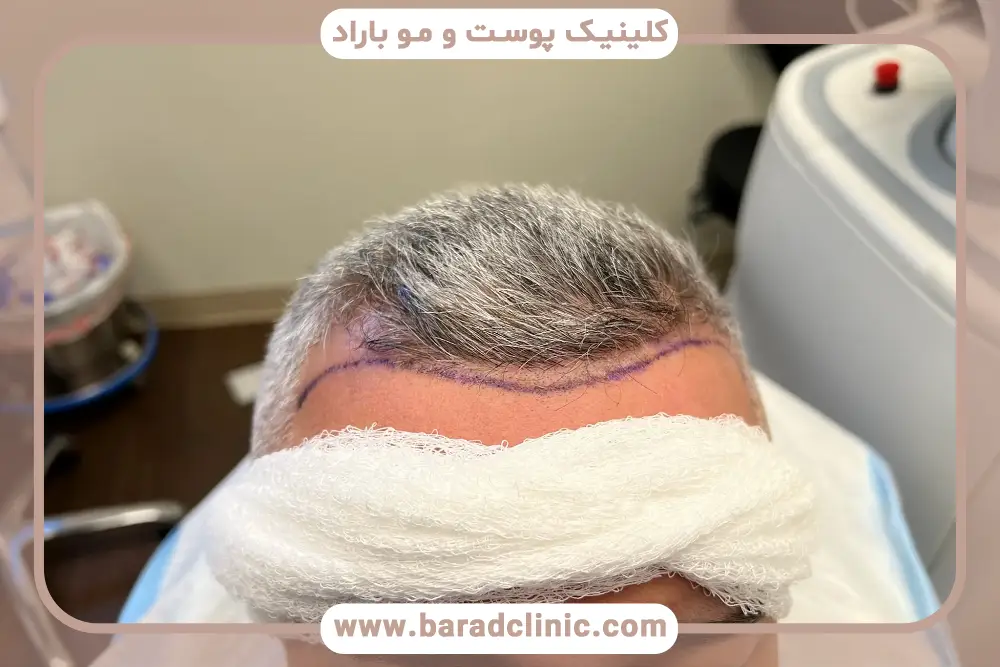 هزینههای بهترین مکان برای کاشت مو