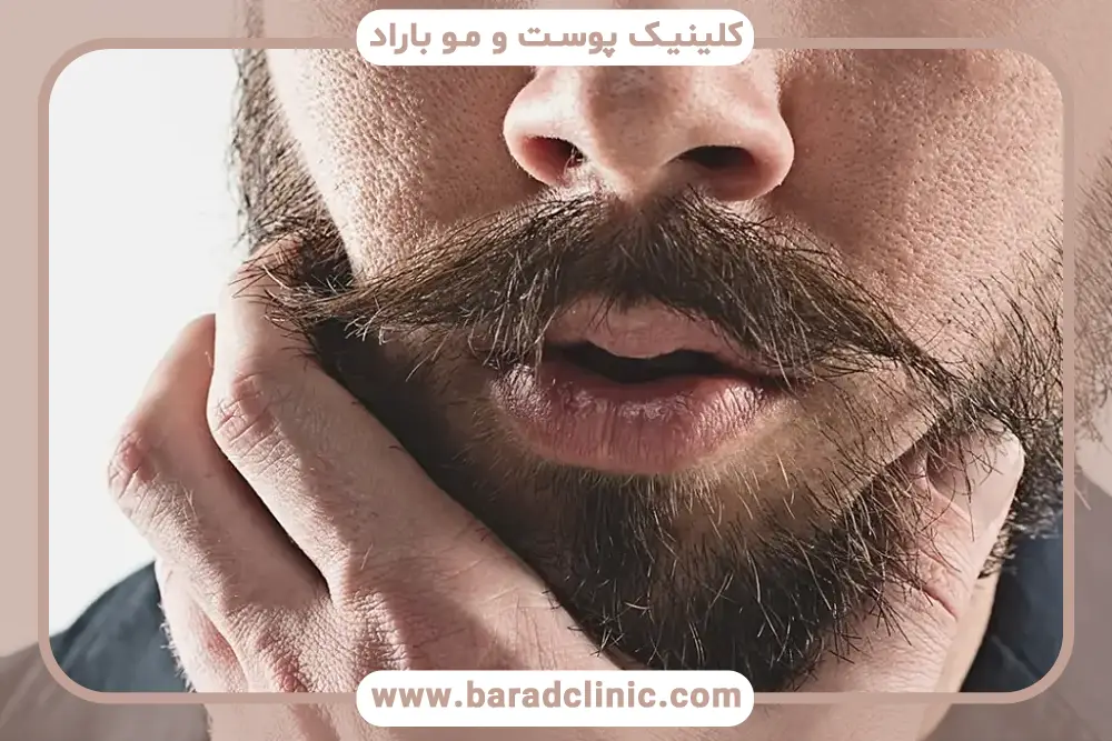 عوامل موثر بر هزینه مزوتراپی ریش و سبیل 