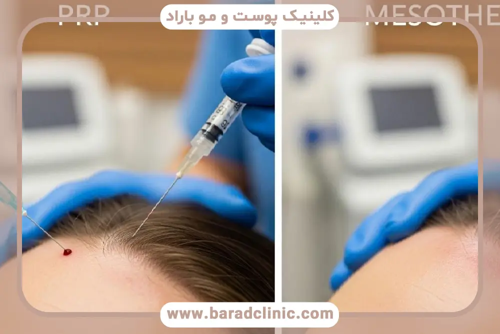 تفاوت مزوتراپی با پی ار پی در مواد تزریقی