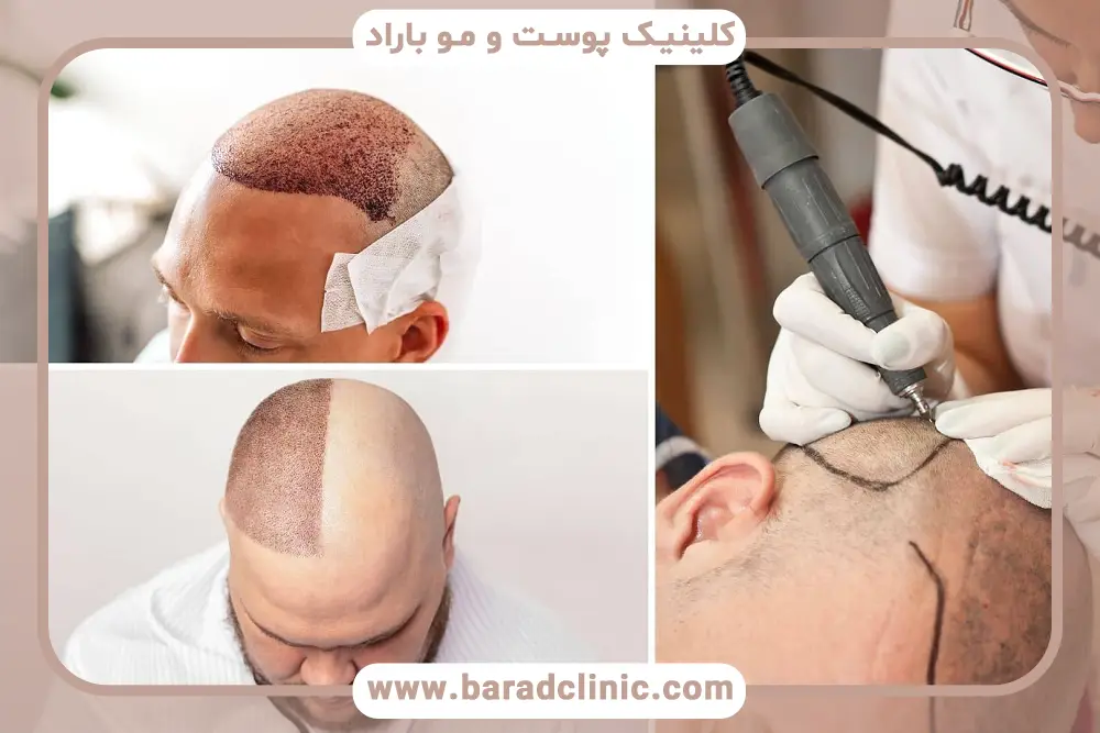 تاثیر کلینیک کاشت مو با مجوز وزارت بهداشت  روی نتیجه نهایی