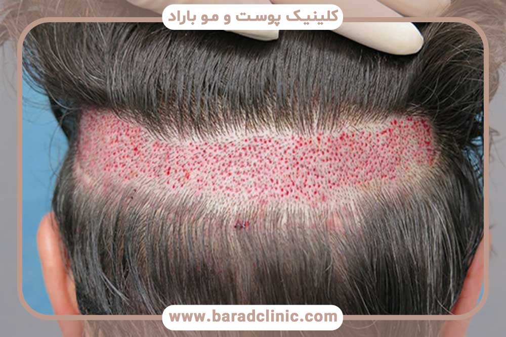 عکس برش سر برای کاشت ابرو