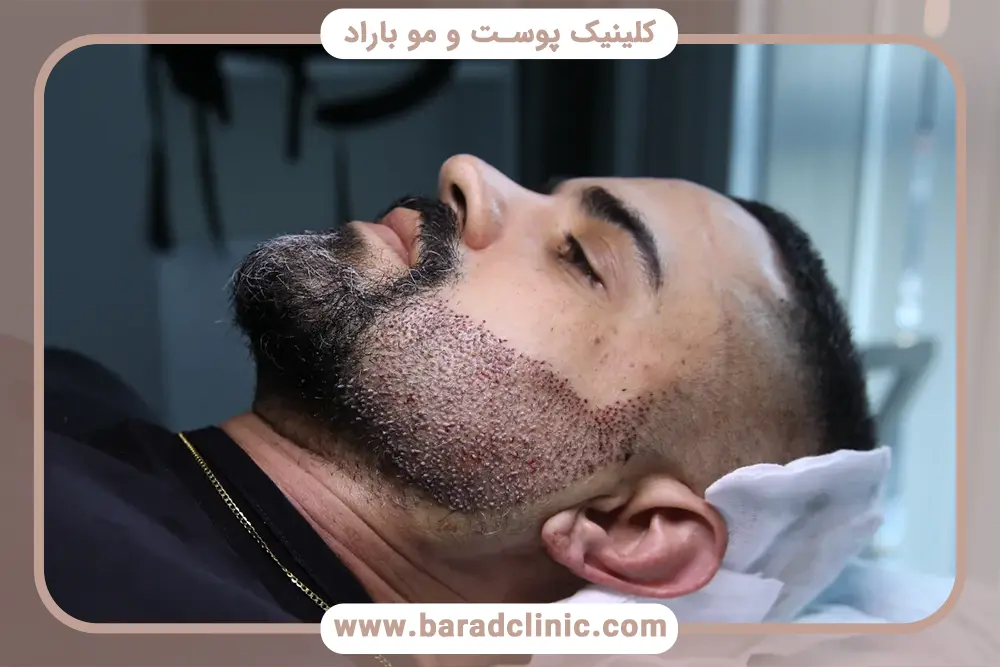 بررسی عوامل موثر بر تغییر قیمت کاشت ریش و سبیل