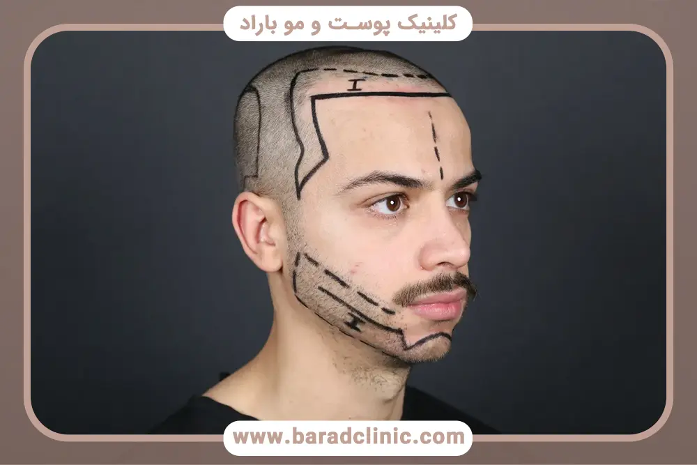 هزینههای جانبی و پنهان در فرآیند کاشت ریش