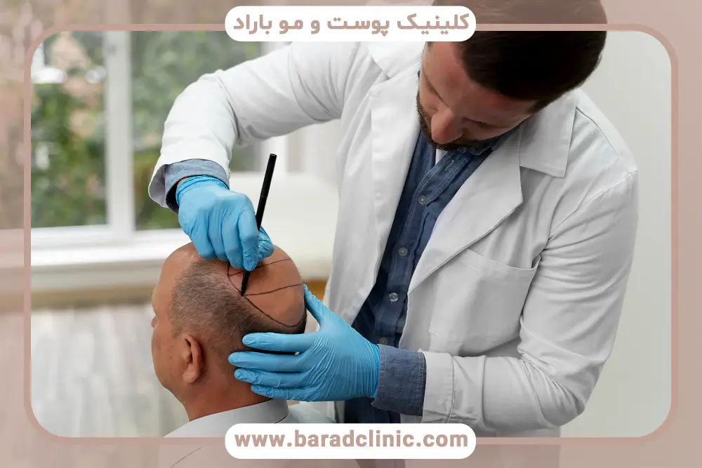 عوامل موثر بر انواع کاشت مو و قیمت آن‌ها