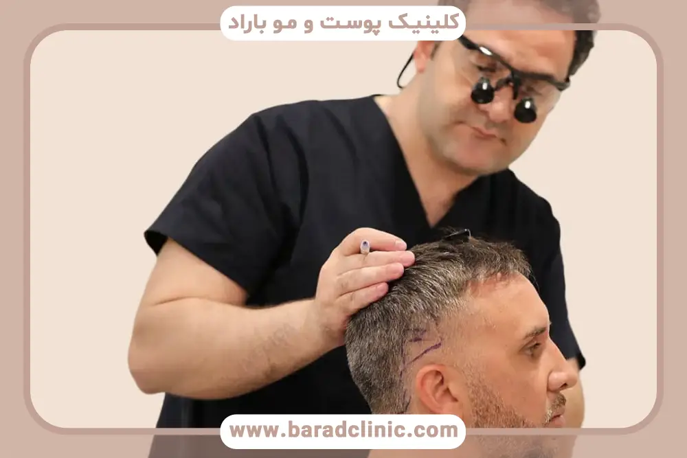 نتیجه نهایی بهترین مکان برای کاشت مو