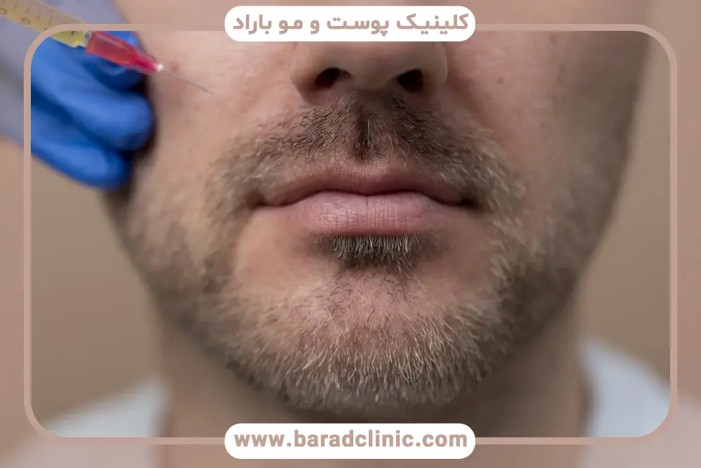 تاثیر برند کوکتل روی هزینه مزوتراپی ریش و سبیل 