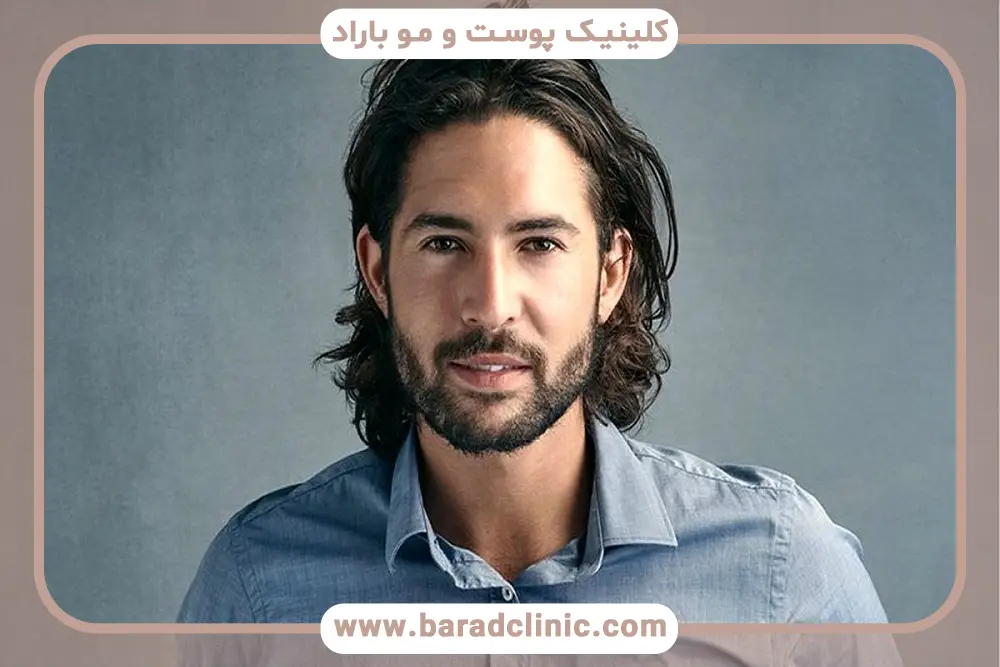 شرایط جسمی برای کاشت مو ایده آل 