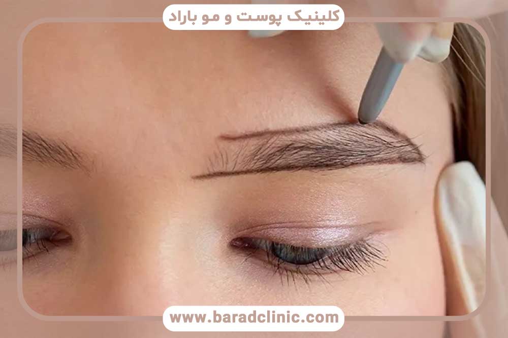 روش آی تی پلاس کاشت ابرو