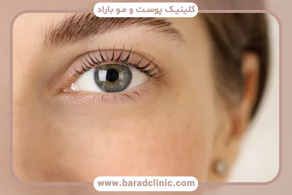 روش آی تی پلاس کاشت ابرو