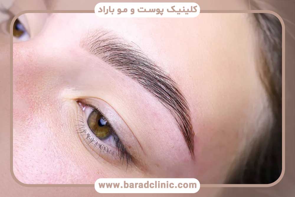 روش آی تی پلاس کاشت ابرو