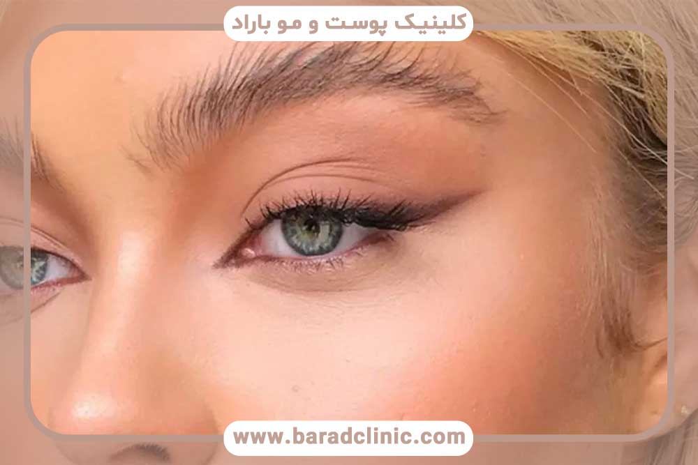فرآیند ترمیم کاشت ابرو