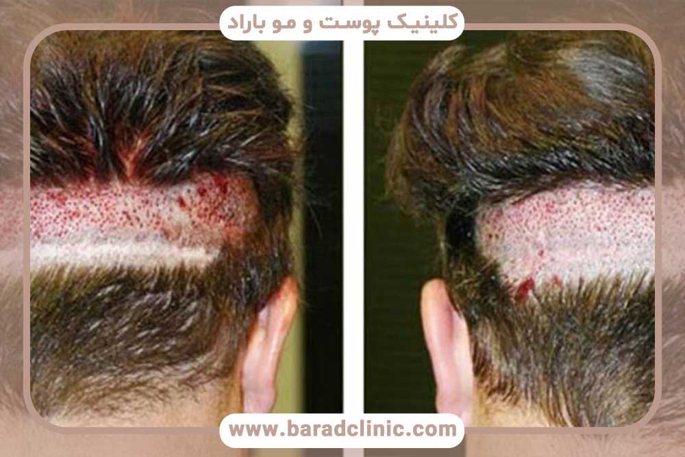 عکس برش سر برای کاشت ابرو