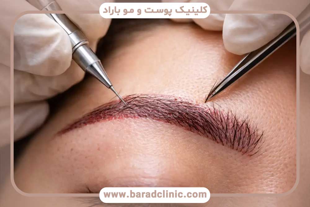 جراحی کاشت ابرو