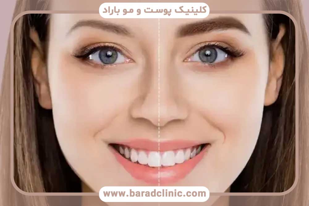 جراحی کاشت ابرو