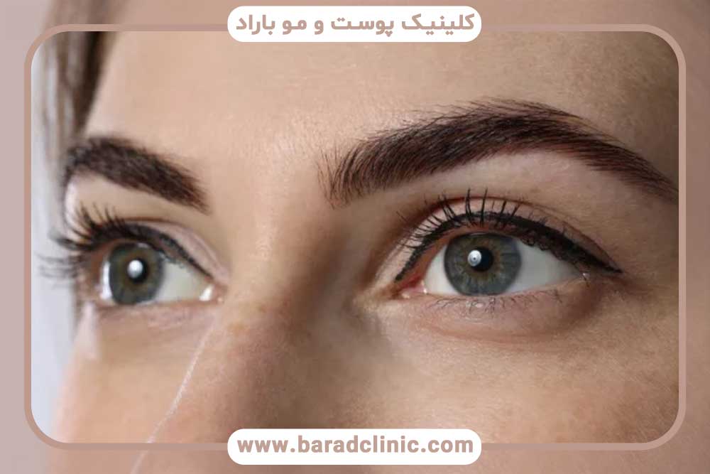 جوش بعد از کاشت ابرو