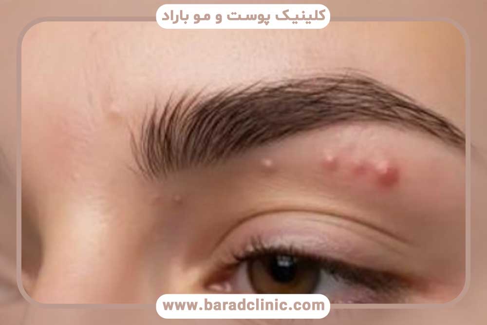 جوش بعد از کاشت ابرو