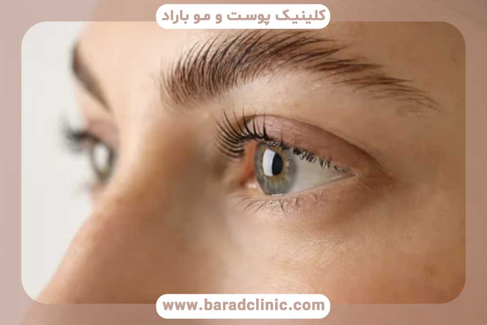 درد کاشت ابرو