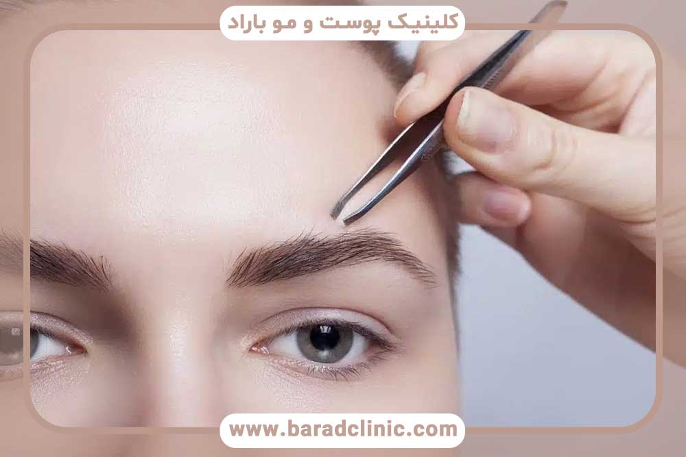 ریزش ابرو بعد از کاشت