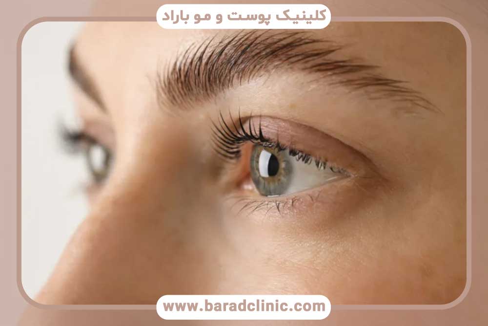 ریزش ابرو بعد از کاشت