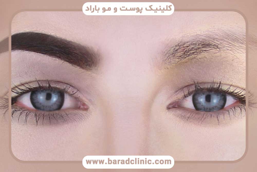 کاشت ابرو بعد از یک ماه