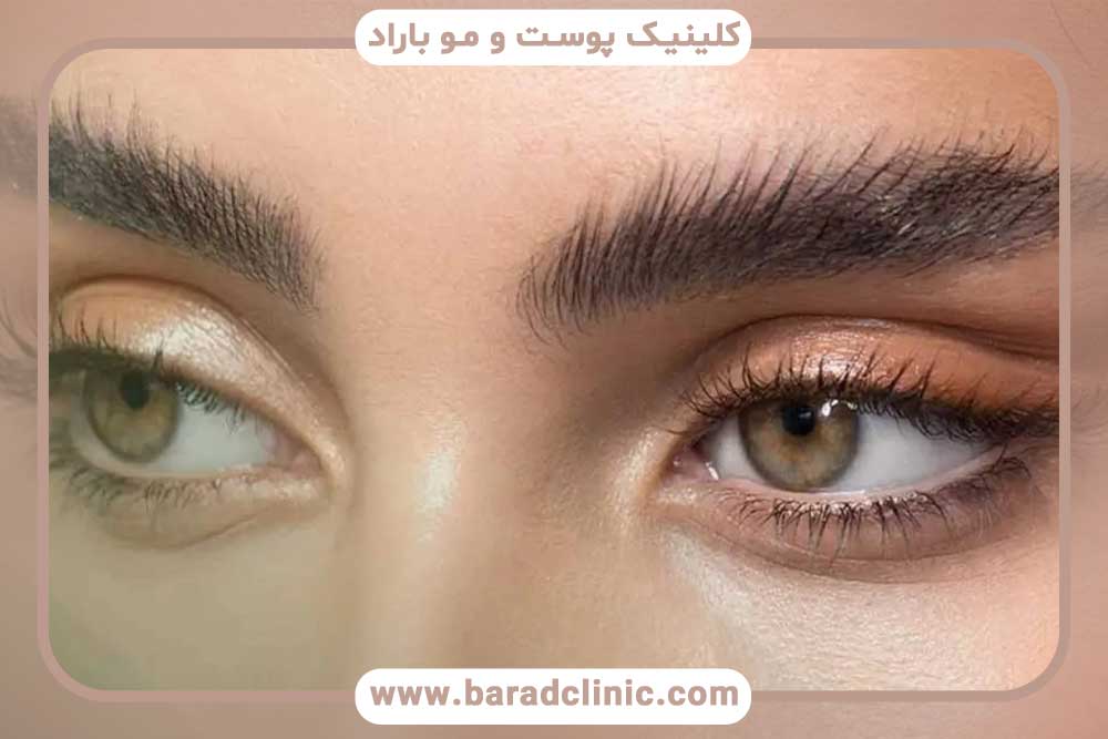 کاشت ابرو بعد از یک ماه