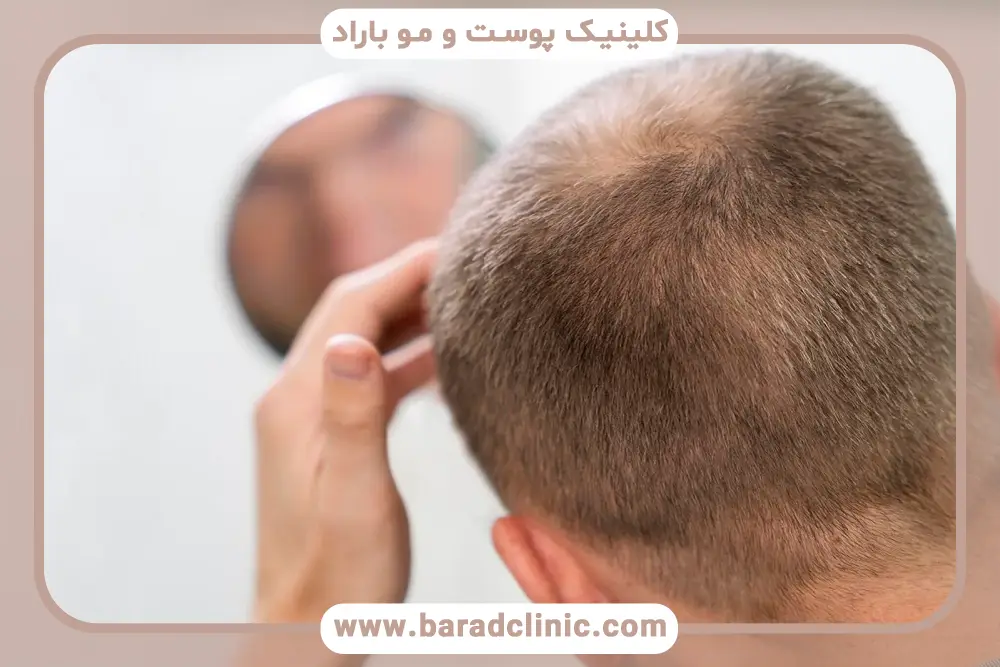 مشاوره آنلاین کاشت مو