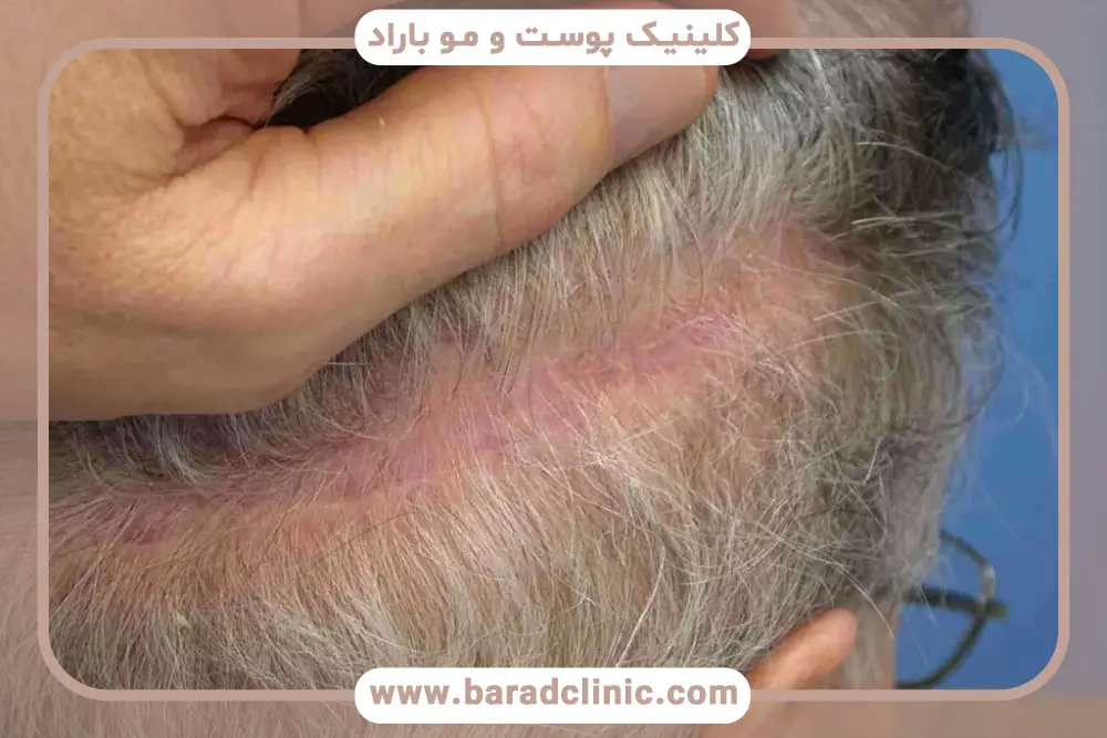 شوک ریزش مو بعد از کاشت