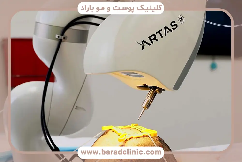 دستگاه کاشت مو اتوماتیک